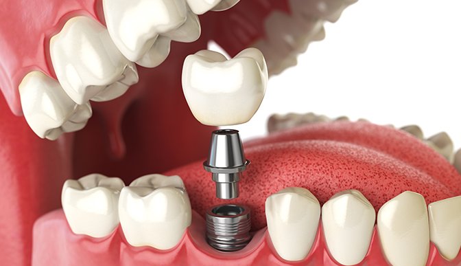 dental implant