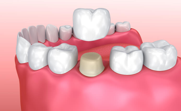 3D illustration of dental crown