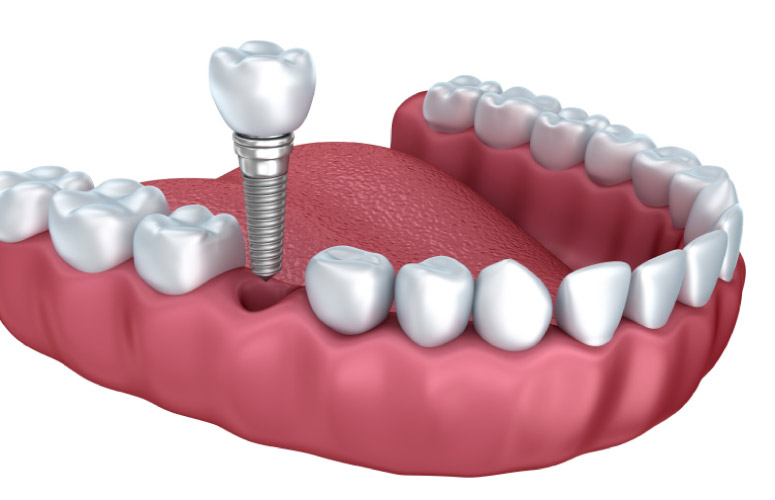 dental implant model to demonstrate tooth loss options