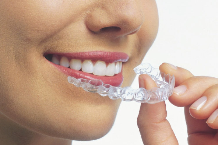 woman inserting Invisalign clean aligner to straighten teeth