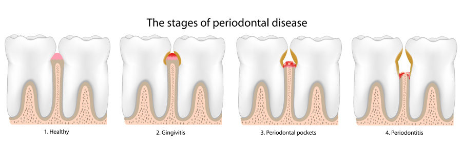 Graphic showing the stages of periodontal or gum disease