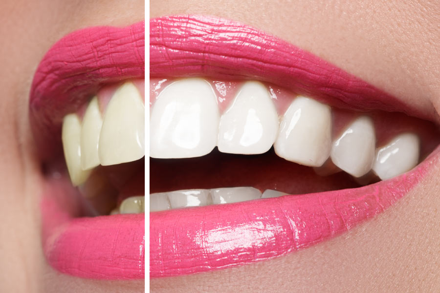 Close up pink lip-sticked smile shows the effects of teeth whitening on half of the smile.