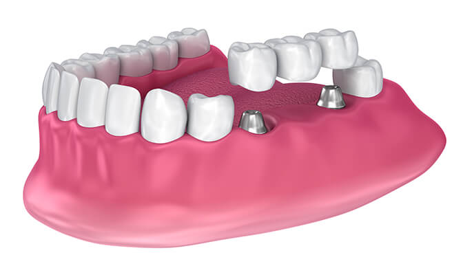 dental bridge illustration