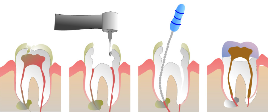 Graphic showing the stages of root canal therapy.