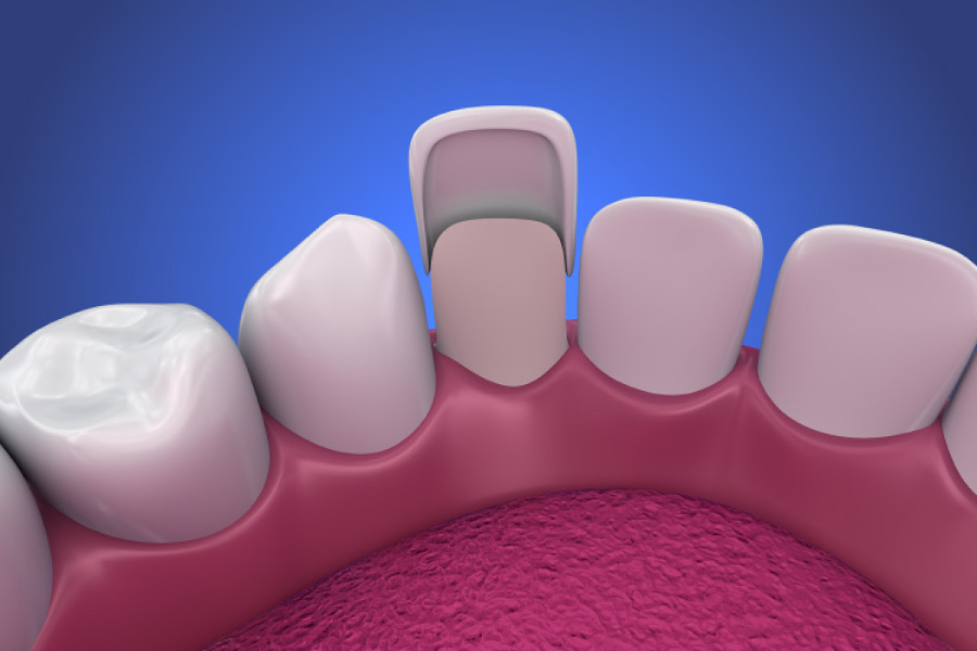 Model showing a porcelain veneer attached to an undersized tooth.