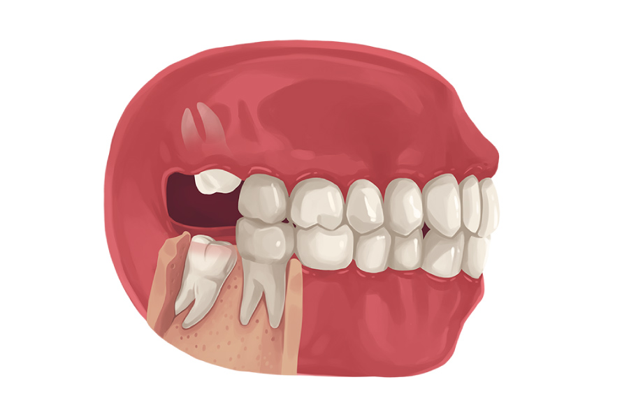 Mouth model showing wisdom teeth growing in at odd angles.