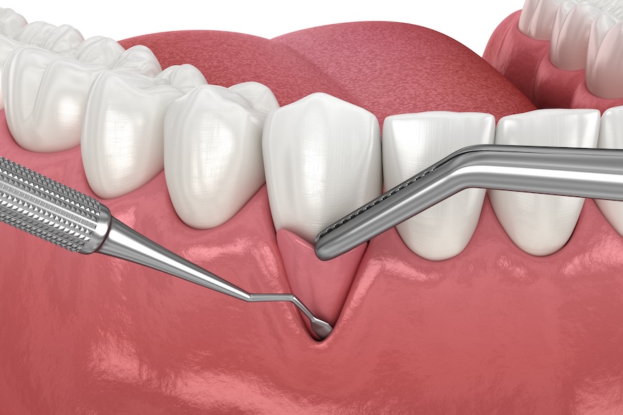 gum graft, Gum Recession: Soft tissue graft surgery. 3D illustration of Dental treatment