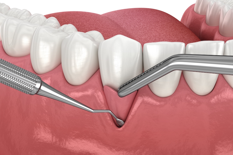 gum graft, Gum Recession: Soft tissue graft surgery. 3D illustration of Dental  treatment