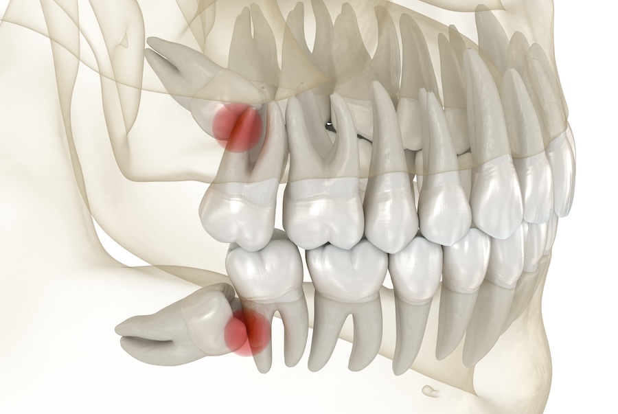 wisdom teeth removal due to impacted wisdom teeth pushing on other molars