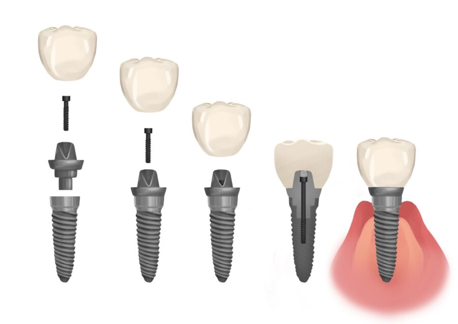 dental implant timeline, procedure, and costs