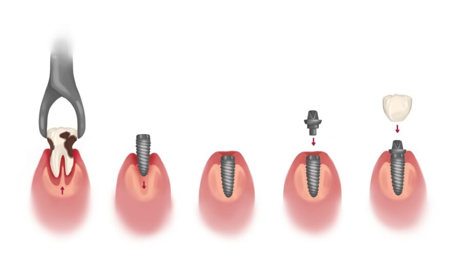 dental implant timeline, dental implants