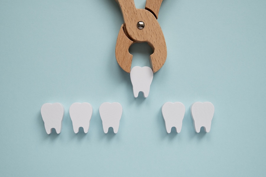 tooth extraction