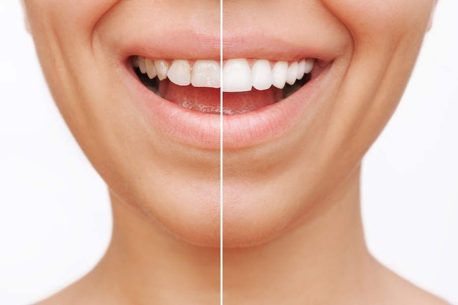 porcelain veneers or teeth whitening