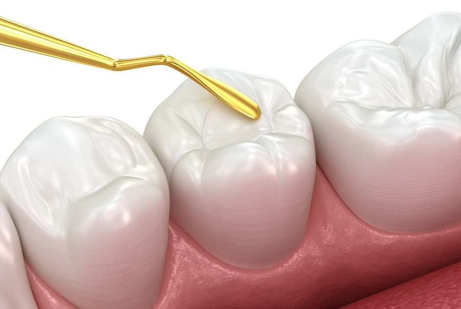 dental filling